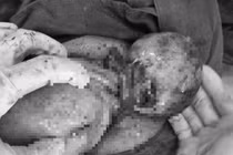  Mổ bắt con thành công cho sản phụ có khối u hoại tử, chèn thai nhi