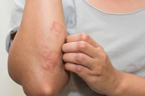 Mẹo phòng ngừa viêm da cơ địa khi trời lạnh