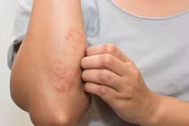 Mẹo phòng ngừa viêm da cơ địa khi trời lạnh