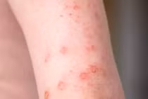 Bệnh giang mai nguy hiểm thế nào?