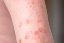 Bệnh giang mai nguy hiểm thế nào?