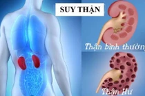 4 sai lầm nguy hiểm khiến bệnh thận tiến triển nhanh hơn