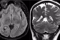Phát hiện sớm hội chứng Sturge-Weber qua chẩn đoán hình ảnh