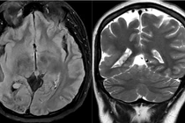 Phát hiện sớm hội chứng Sturge-Weber qua chẩn đoán hình ảnh