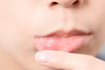 Lô Gel nhiệt miệng Fobe Mouth Ulce bị thu hồi do không đạt chất lượng