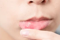 Lô Gel nhiệt miệng Fobe Mouth Ulce bị thu hồi do không đạt chất lượng