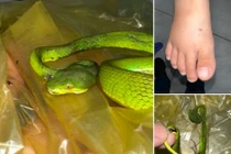 Bé trai bị rắn lục đuôi đỏ cắn nguy kịch 