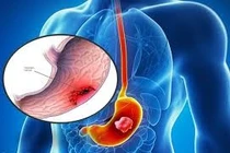 Trẻ 13 tuổi phải phẫu thuật vì thủng ổ loét dạ dày do thói quen sinh hoạt xấu