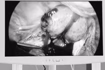 Phẫu thuật cấp cứu kịp thời cho một phụ nữ chửa ngoài tử cung vỡ mất máu 