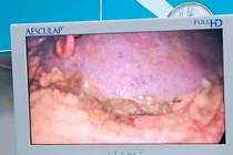 Cứu sống bệnh nhân thủng dạ dày do tự ý dùng thuốc giảm đau