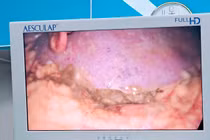 Cứu sống bệnh nhân thủng dạ dày do tự ý dùng thuốc giảm đau