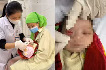 Trẻ sơ sinh bị viêm kết mạc do cha mẹ tự ý dùng biện pháp dân gian