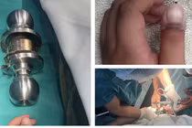 Bé 5 tuổi mắc kẹt ngón tay vào ổ khóa, thoát hiểm ngoạn mục