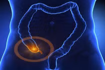 Ung thư ruột thừa hiếm gặp được phát hiện kịp thời trong phẫu thuật