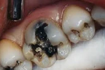 Thực phẩm chứa nhiều đường gây hại men răng