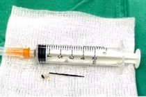 Cứu sống bệnh nhân 68 tuổi bị dị vật kim loại xuyên thủng dạ dày