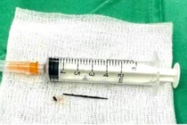 Cứu sống bệnh nhân 68 tuổi bị dị vật kim loại xuyên thủng dạ dày