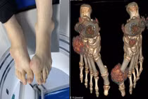 Nam thanh niên 23 tuổi biến dạng khớp do gout nặng