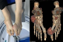 Nam thanh niên 23 tuổi biến dạng khớp do gout nặng