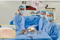 Phẫu thuật thành công khối u buồng trứng nặng 20,5 kg