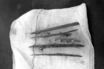 Nữ bệnh nhân phải nhập viện mổ cấp cứu do nuốt 3 tăm tre