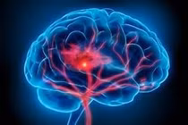 Hành trình cứu sống bệnh nhân đột quỵ với hai lần can thiệp thành công