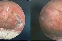 Phẫu thuật thành công u máu amidan cho trẻ 14 tuổi tại Hà Nội