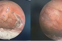 Phẫu thuật thành công u máu amidan cho trẻ 14 tuổi tại Hà Nội