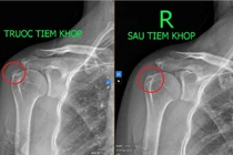 Viêm gân vôi hóa – bệnh lý cơ xương khớp thường gặp ở lứa tuổi trung niên