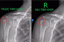 Viêm gân vôi hóa – bệnh lý cơ xương khớp thường gặp ở lứa tuổi trung niên