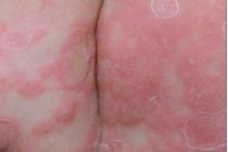 Phát hiện sớm trẻ bị giang mai bẩm sinh từ mẹ không được điều trị đúng cách