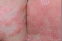 Phát hiện sớm trẻ bị giang mai bẩm sinh từ mẹ không được điều trị đúng cách