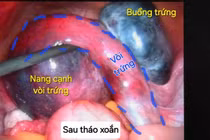 Hai ca xoắn cơ quan sinh dục nguy hiểm được cấp cứu kịp thời