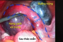 Hai ca xoắn cơ quan sinh dục nguy hiểm được cấp cứu kịp thời