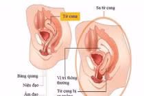 Phẫu thuật thành công cho một phụ nữ lớn tuổi bị sa tử cung ra ngoài âm đạo