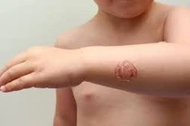 Bệnh chốc lở ở trẻ em có biểu hiện thế nào?