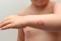 Bệnh chốc lở ở trẻ em có biểu hiện thế nào?