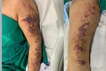 Nguy cơ mắc liên cầu lợn qua thực phẩm không đảm bảo an toàn