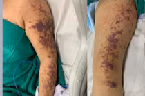 Nguy cơ mắc liên cầu lợn qua thực phẩm không đảm bảo an toàn