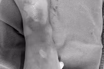 3 trẻ trong một gia đình bị bỏng khi ăn lẩu