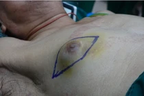 Cụ ông 86 tuổi mắc ung thu vú, căn bệnh tưởng chừng chỉ gặp ở phụ nữ