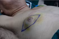 Cụ ông 86 tuổi mắc ung thu vú, căn bệnh tưởng chừng chỉ gặp ở phụ nữ