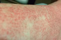 Cô gái trẻ suýt mất mạng vì sốc sốt xuất huyết Dengue