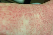 Cô gái trẻ suýt mất mạng vì sốc sốt xuất huyết Dengue