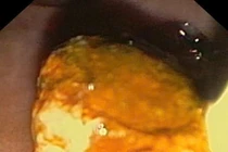 Xử lý thành công ca mổ sỏi ống mật chủ nặng