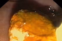 Xử lý thành công ca mổ sỏi ống mật chủ nặng