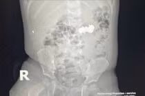 Trẻ nhỏ nuốt 4 viên đinh nam châm nguy hiểm, được cứu kịp thời tại Nghệ An