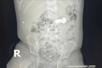 Trẻ nhỏ nuốt 4 viên đinh nam châm nguy hiểm, được cứu kịp thời tại Nghệ An