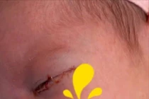 Chẩn đoán sớm viêm kết mạc sơ sinh giúp giảm nguy cơ biến chứng nặng