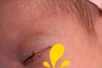 Chẩn đoán sớm viêm kết mạc sơ sinh giúp giảm nguy cơ biến chứng nặng